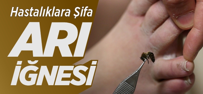 HASTALIKLARA ŞİFA ARI İĞNESİ